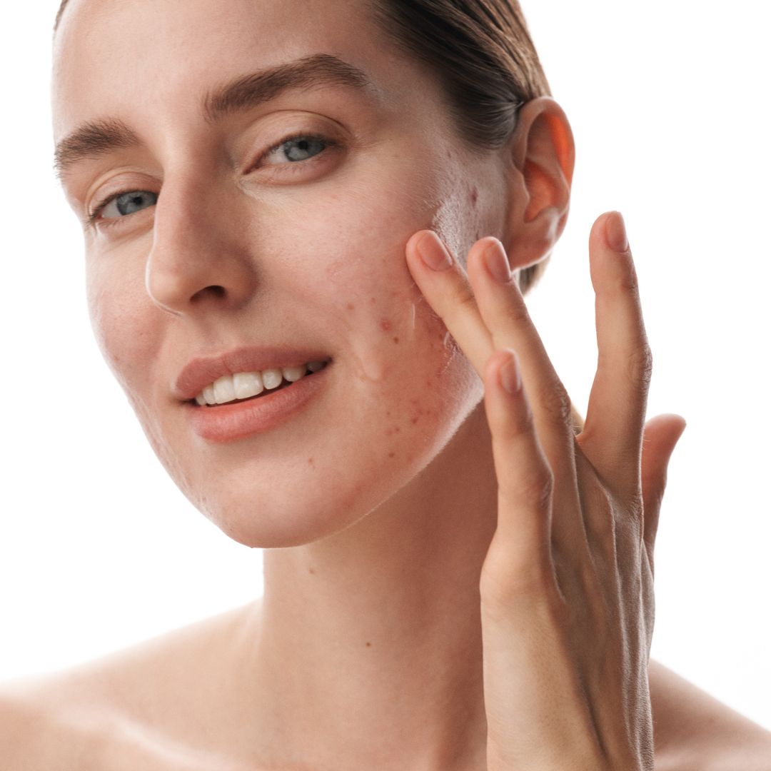 Moteris tepa drėkinamąjį serumą ant aknės pažeistos veido odos.