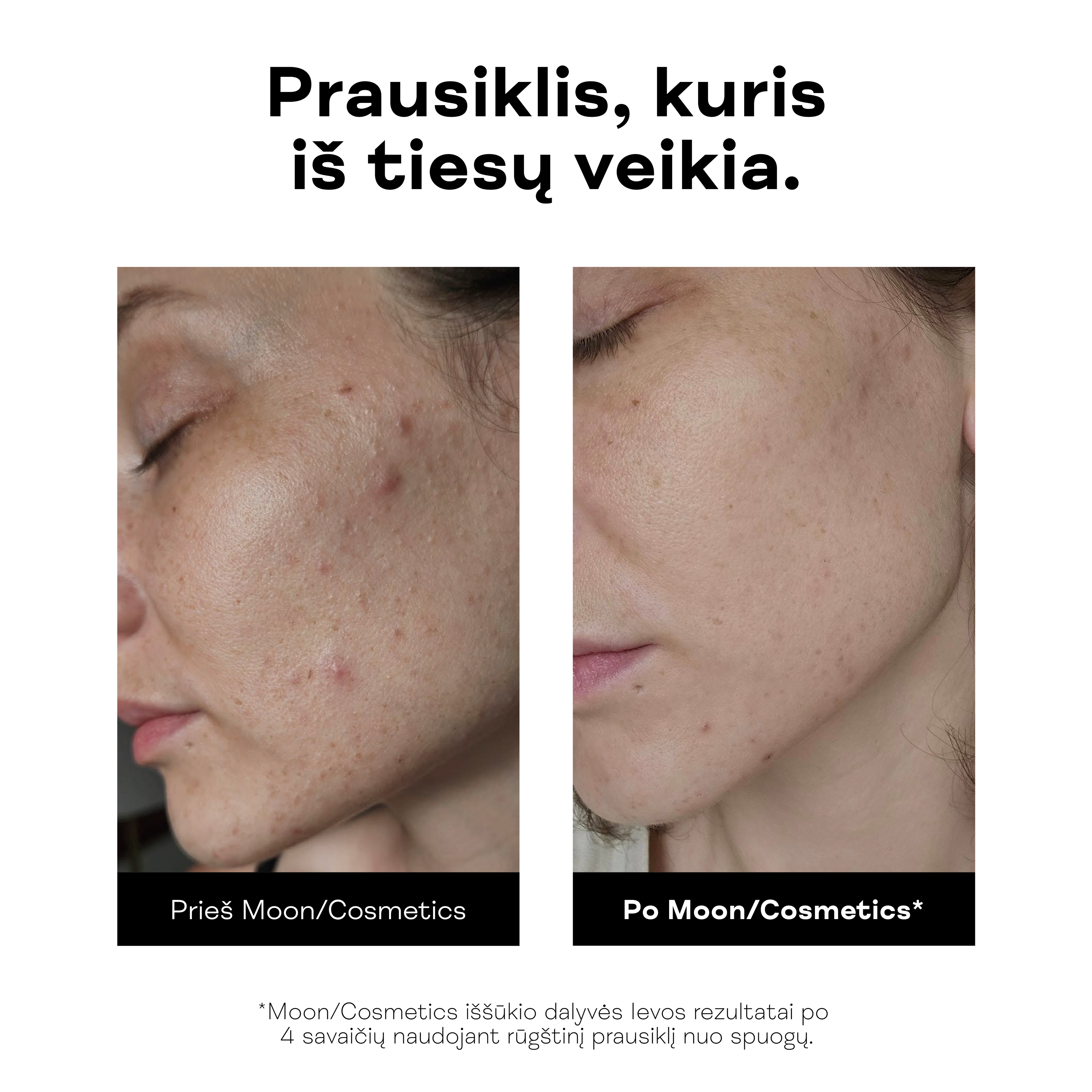 Moteris rodo išvalytą, skaistesnę odą po rūgštinio veido prausiklio nuo spuogų.