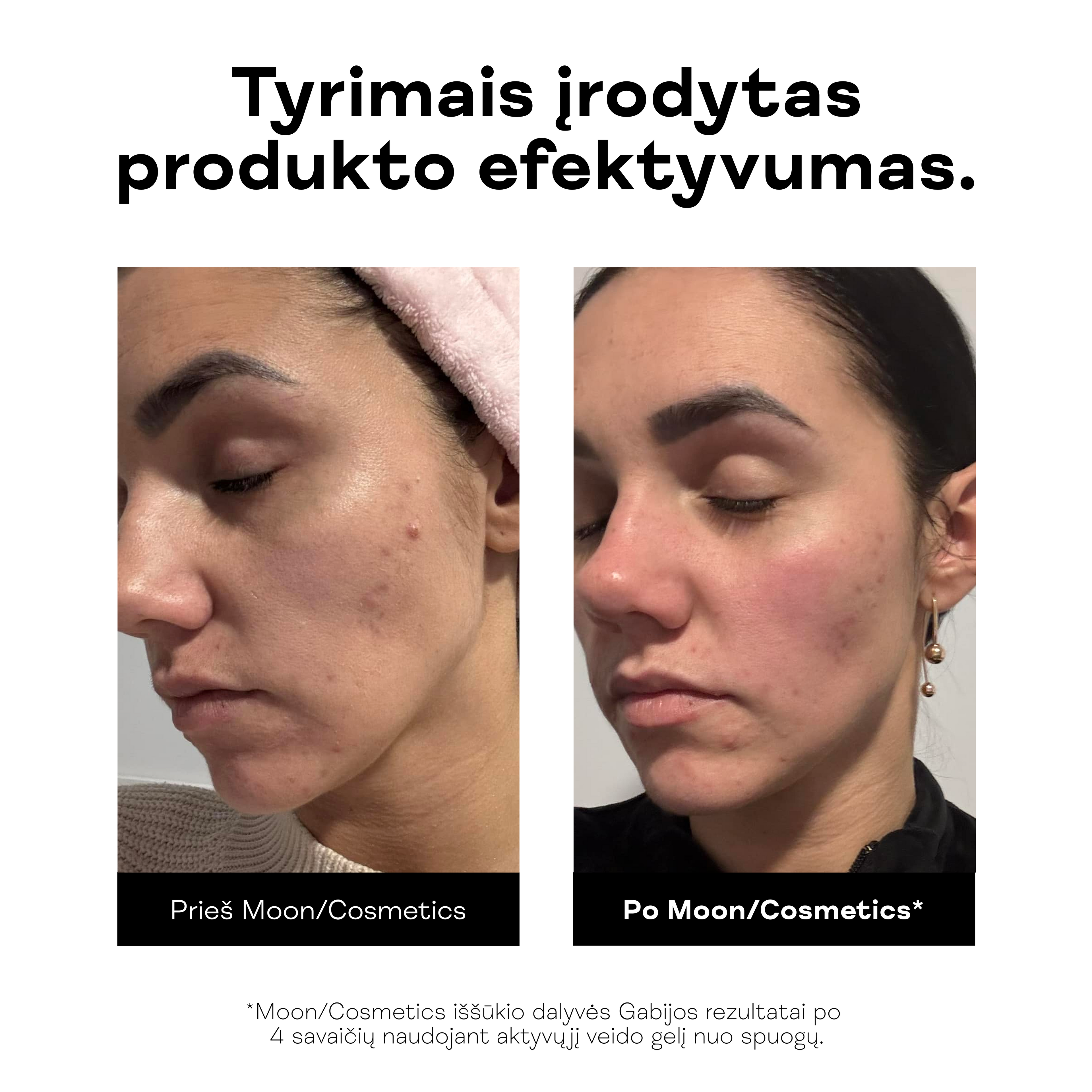 Moteris rodo skaistesnę, mažiau spuoguotą veido odą po Aktyviojo veido gelio nuo spuogų naudojimo.