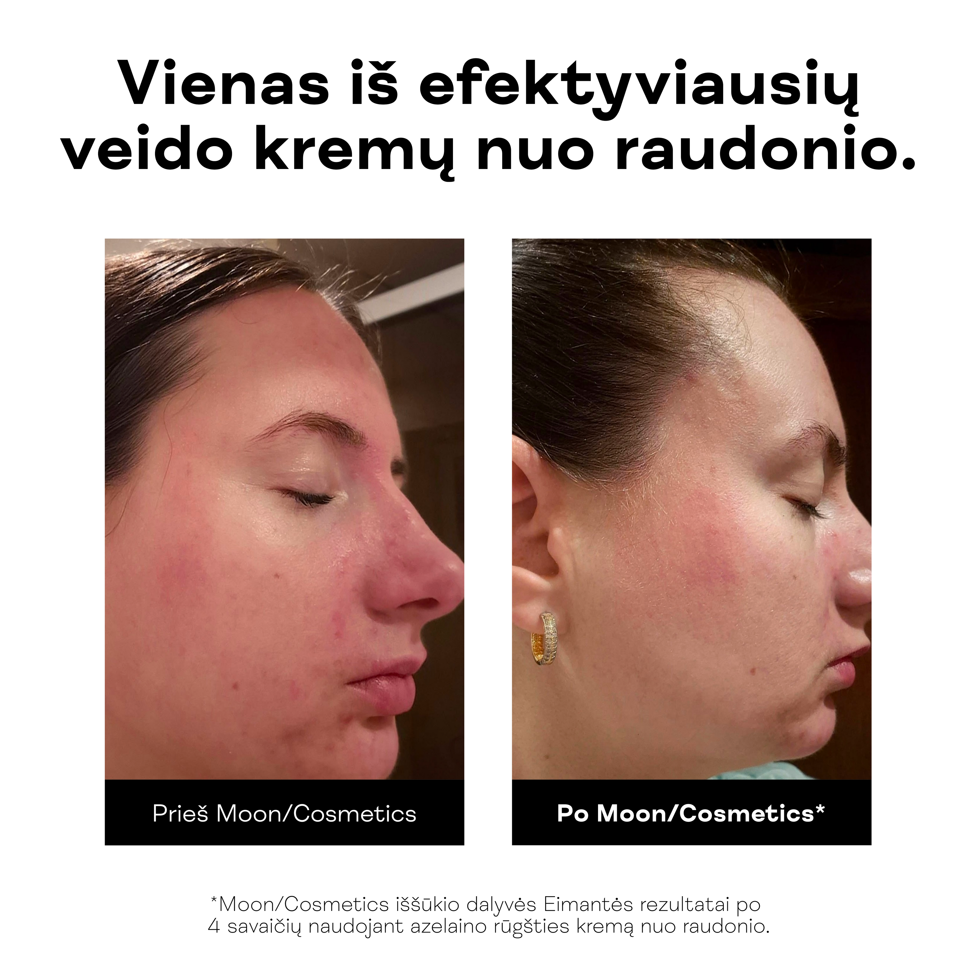 Moteris rodo sumažėjusį veido raudonį po azelaino rūgšties kremo nuo raudonio naudojimo.