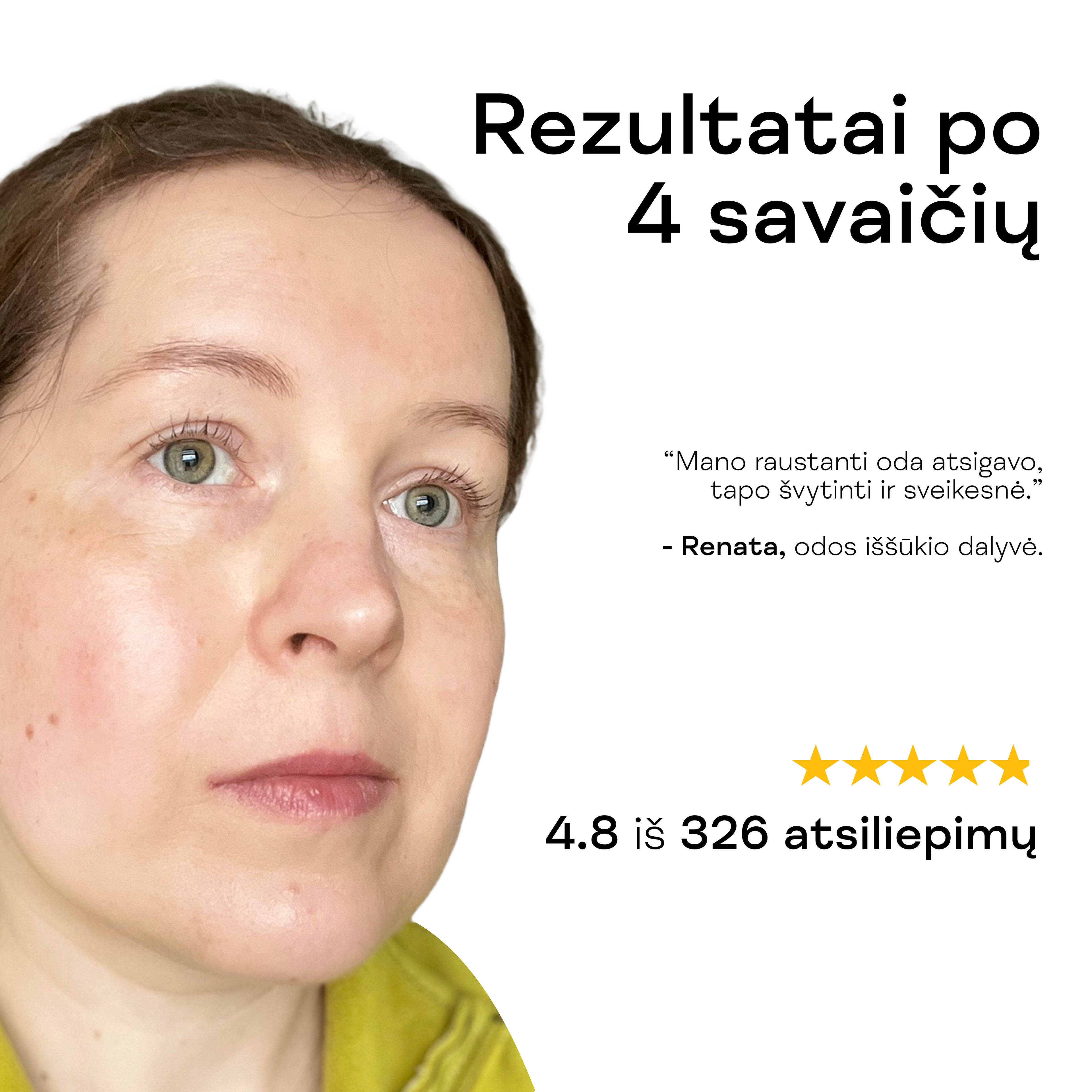 Moteris rodo atsigavusią, švytinčią odą po Azelaino rūgšties kremo nuo raudonio naudojimo.