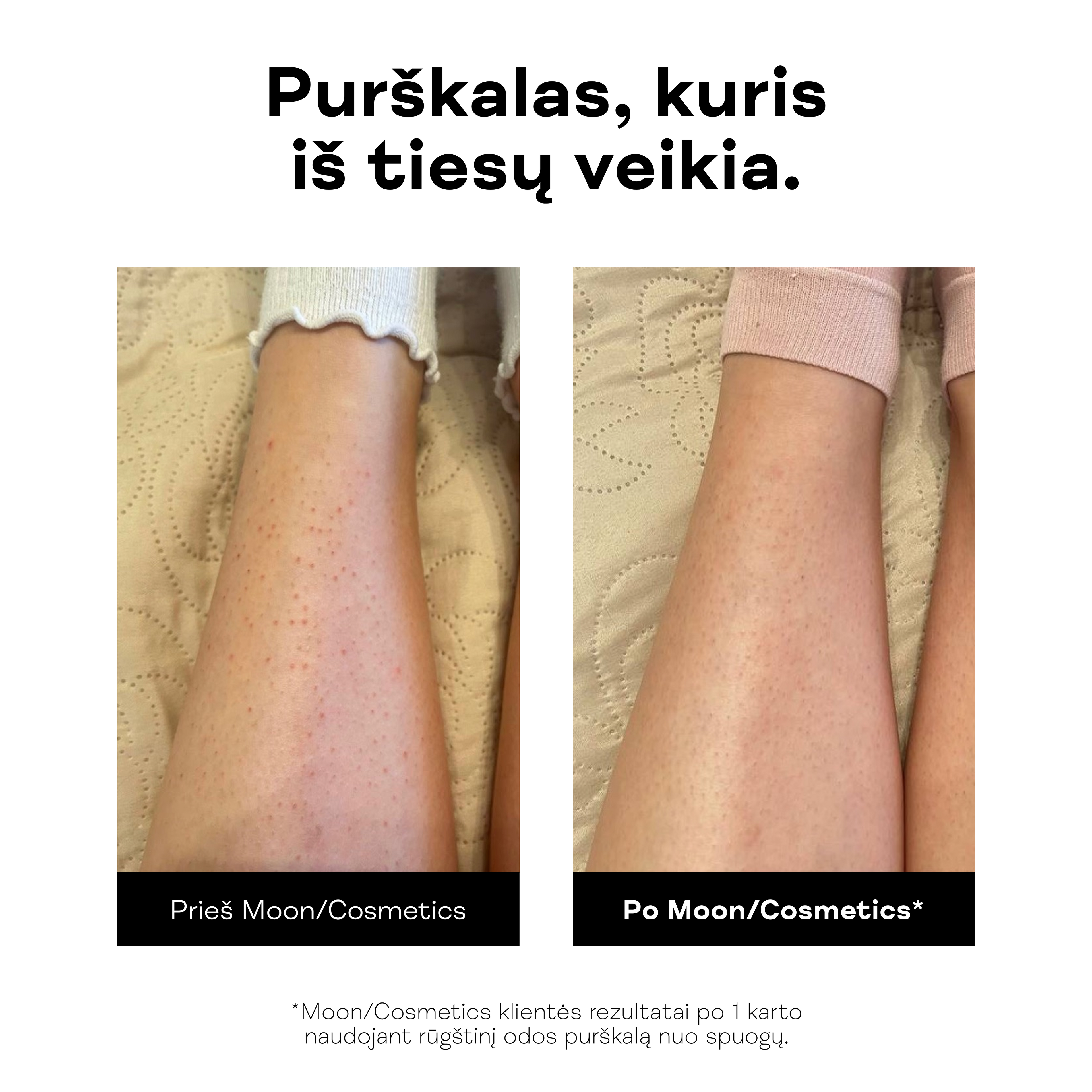 Rūgštinis odos purškalas nuo spuogų