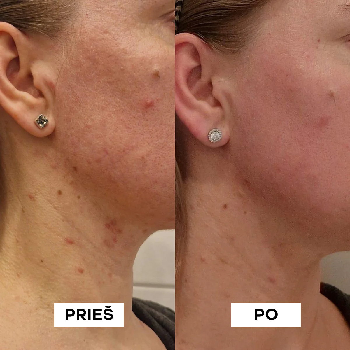 Moteris rodo veido ir kaklo odos pagerėjimą po aknės gydymo procedūros.