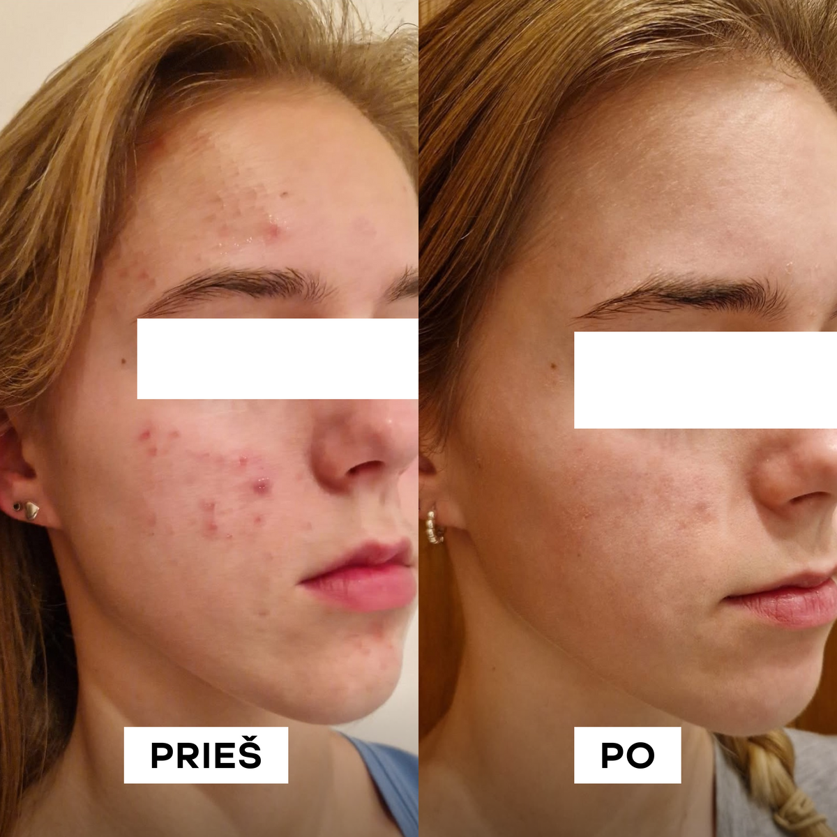 Moteris rodo pagerėjusią veido odą po aknės procedūros.