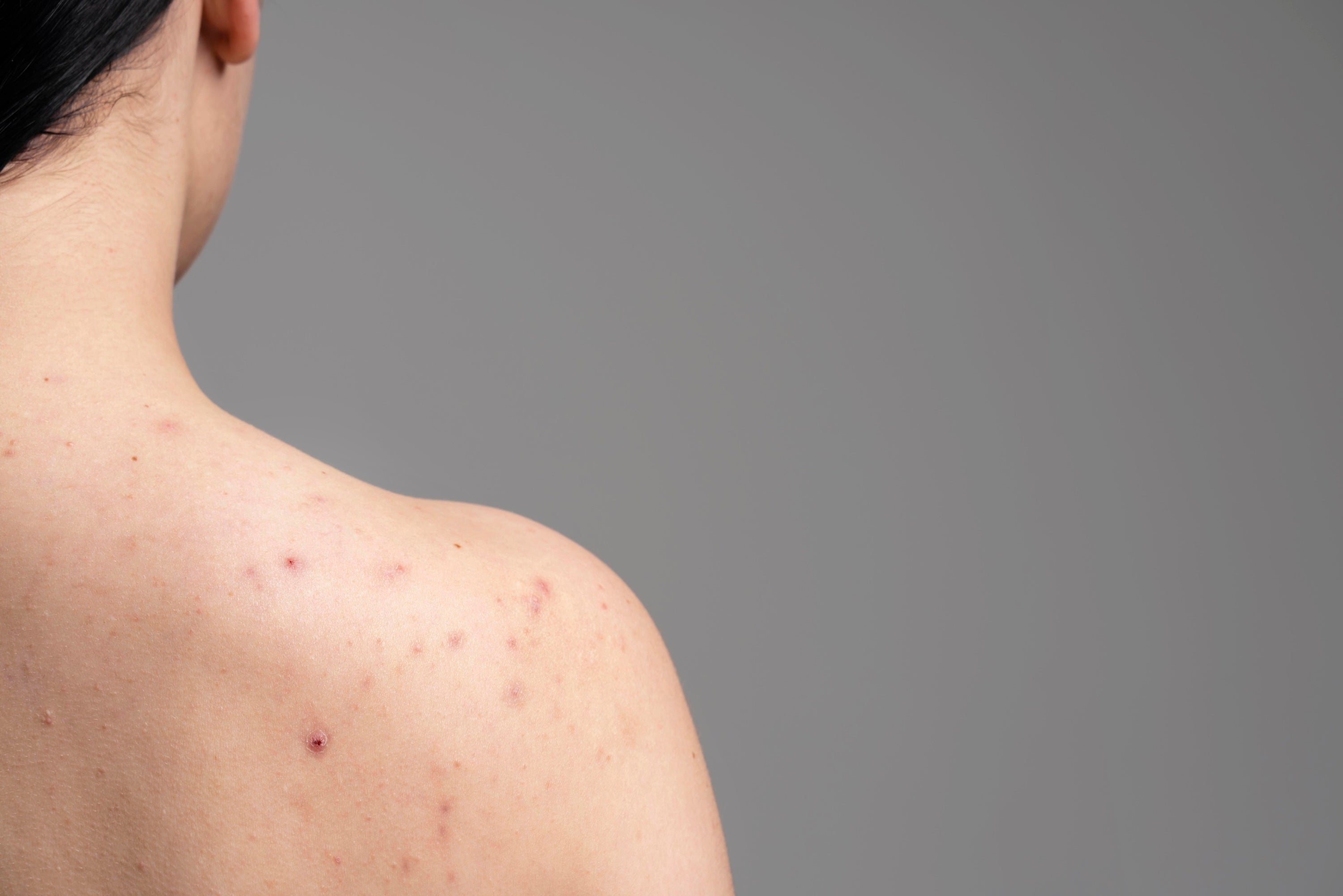 Nugaros spuogai (Bacne) ir aknė ant nugaros: Priežastys ir efektyvus gydymas
