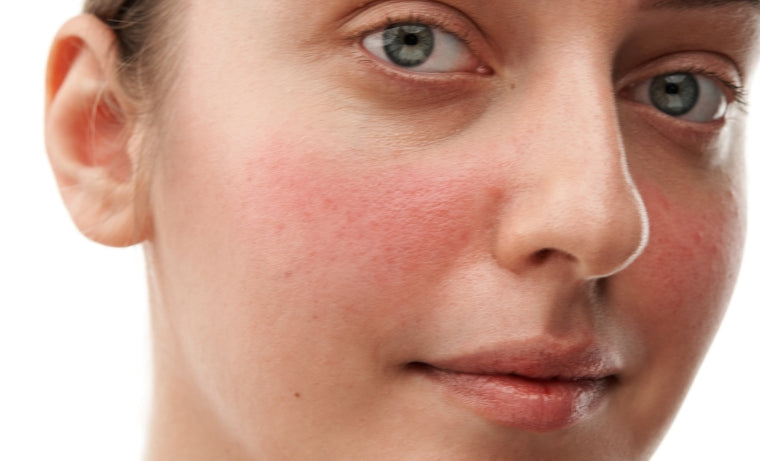 Kaip prižiūrėti jautrią odą?