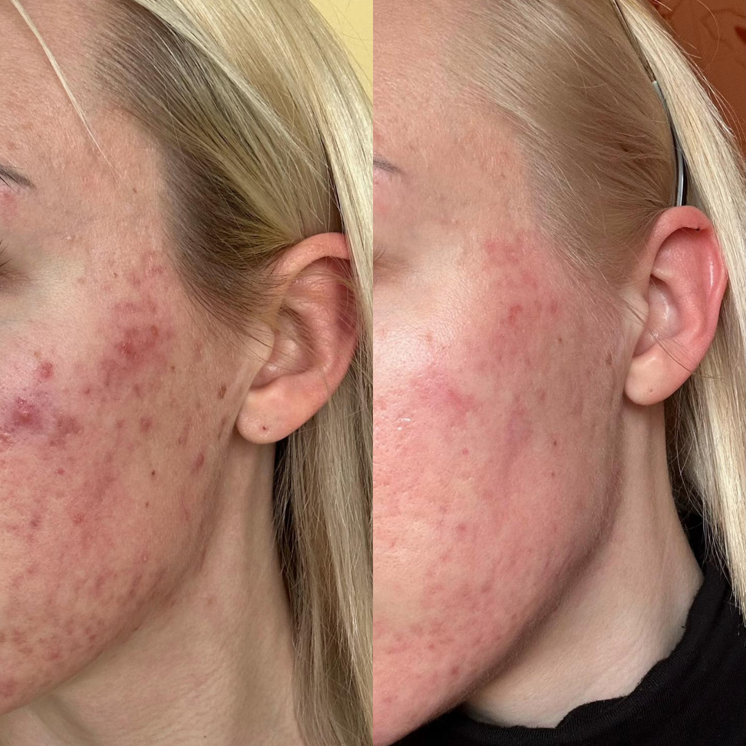 Acne/Treatment procedūra