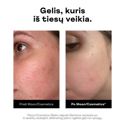 Pieno rūgšties gelis nuo spuogų