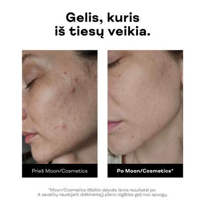 Gelis nuo spuogų